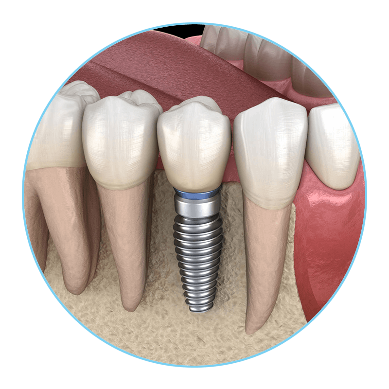 bone grafting for patients