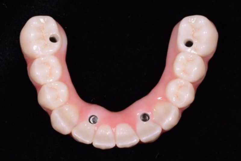 full arch implant bridge