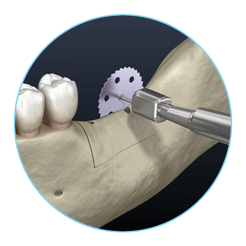 ridge augmentation