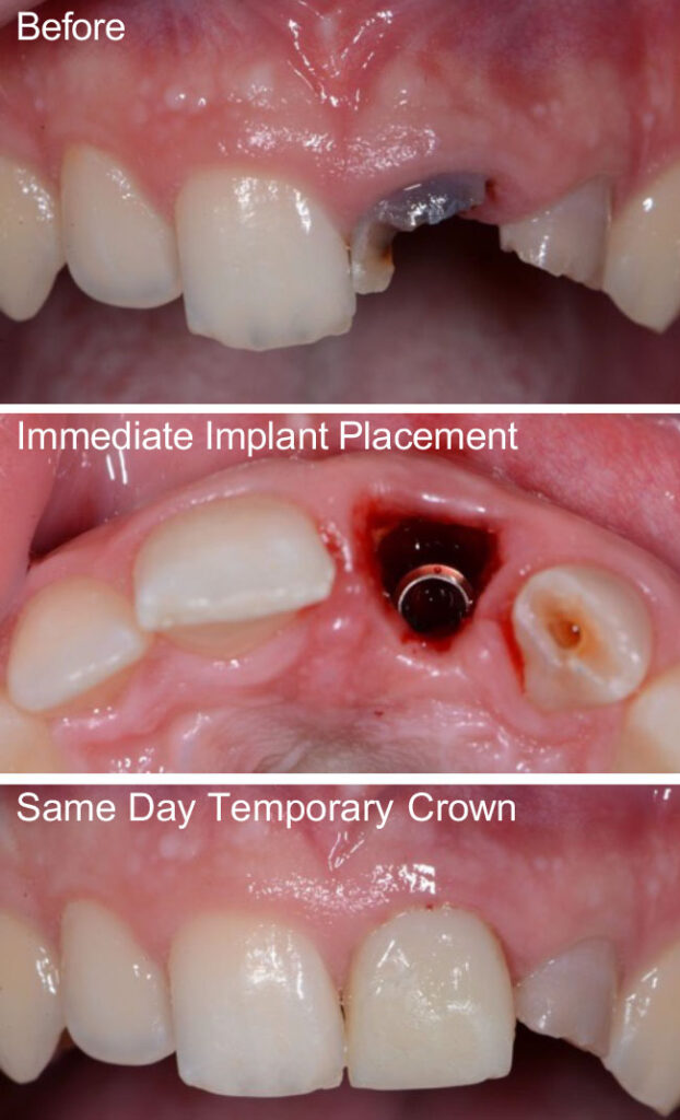 same day dental implant dr joseph lee