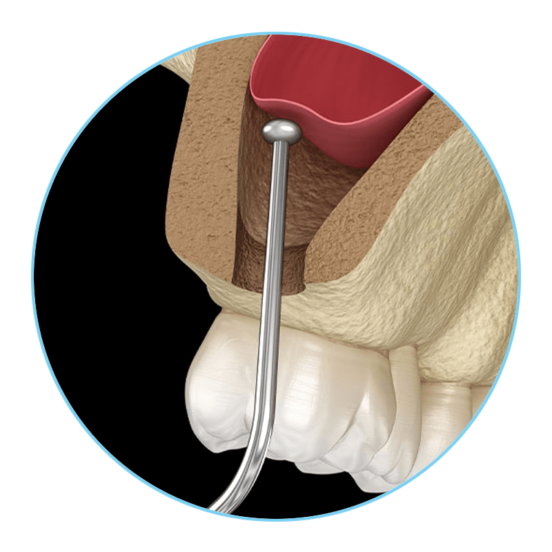 sinus lifts