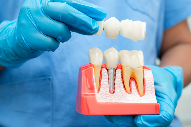 A dental professional wearing blue gloves holds a model of a human jaw, demonstrating a dental implant with an attached dental bridge. The implant is shown embedded in the gum with surrounding natural teeth.